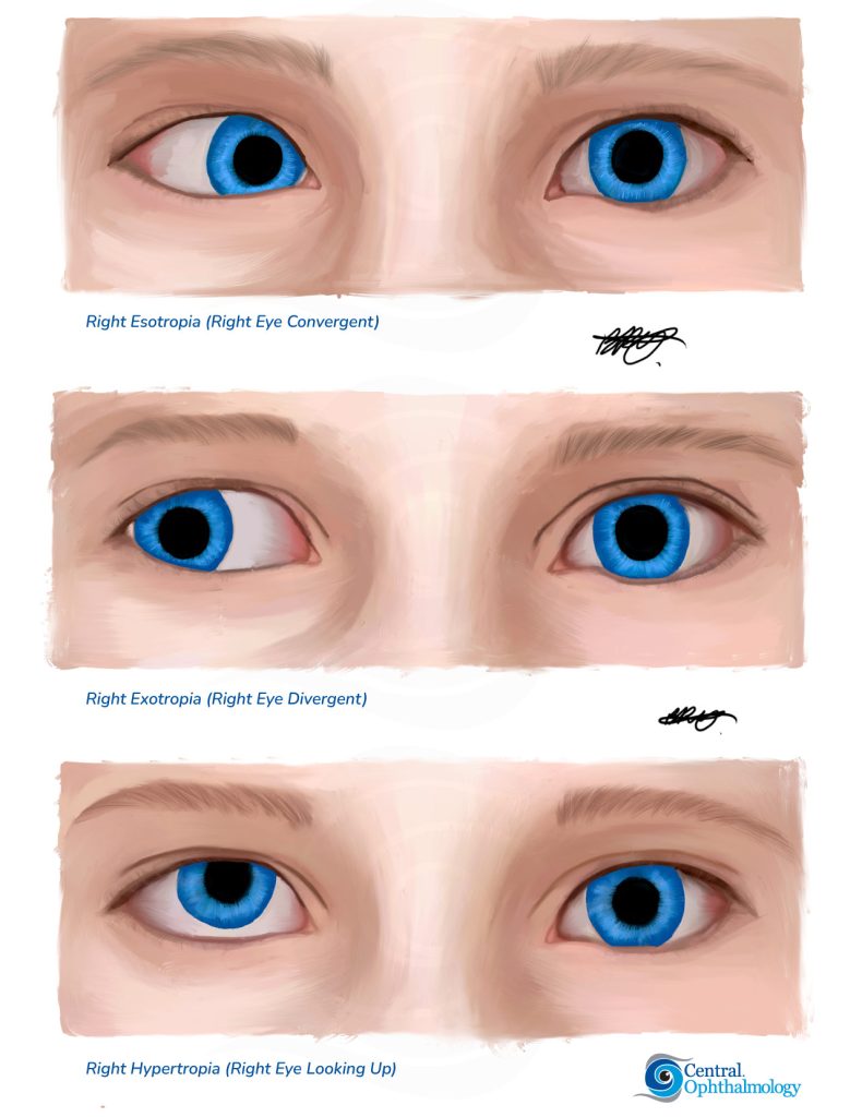 Strabismus Squint Sunshine Coast Squint Surgery 